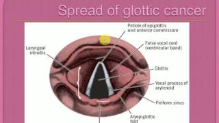 ENT LECTURES  CANCER LARYNX Part 1  CLASSIFICATION [upl. by Anod]