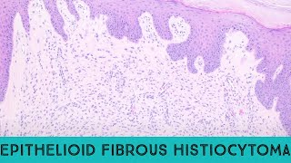 Epithelioid fibrous histiocytoma benign ALK1 skin tumor ALK gene fusion pathology dermpath [upl. by Colene690]