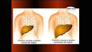 Salud ¿Qué es la hepatomegalia [upl. by Ridinger573]