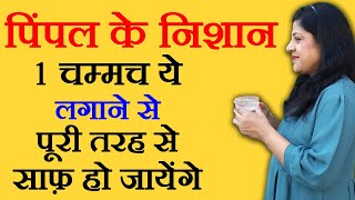 पिम्पल के दाग कैसे हटाये How To Remove Pimple Marks by Sonia Goyal  pimple ke daag hatane ke upay [upl. by Bigot]