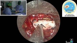 Rt L5S1 endo discectomy [upl. by Anaher]