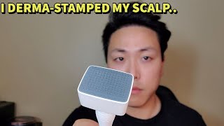 I USED A DERMA STAMP FOR HAIR GROWTH AND THIS IS WHAT I THOUGHT OF IT [upl. by Nesta]