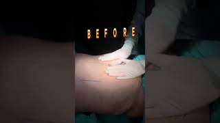 Tummy Tuck  Before and After  Karın Germe tummytuckrecovery abdomen [upl. by Anrol785]