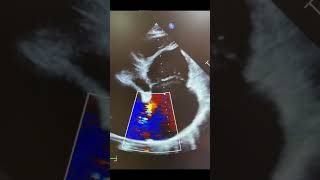 Atrial septal defect in adult [upl. by Pendleton]