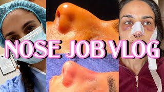 NOSE JOB VLOG emotional reveal rhinoplasty  Closet Raid [upl. by Joanna]