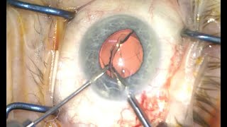 Multifocal removal and replacement with an Acufocus IC8 pinhole lens [upl. by Glenine423]