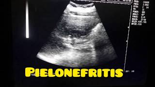 PIELONEFRITIS CASO CLÍNICO CÓLICO RENAL INFECCIÓN DE VÍAS URINARIAS [upl. by Mathe31]