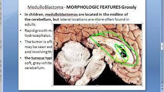 Pathology 897 a Medulloblastoma brain Homer Wright psuedorosettes Drop metastases child tumor cauda [upl. by Quickman272]