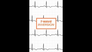 T Wave Inversion [upl. by Annelise754]