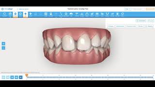 Invisalign Deep Bite and Diastema Correction How I engineer tooth movement Nirenblatt Orthodontics [upl. by Ribak]