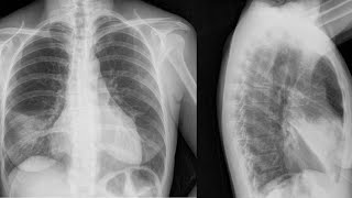 BRONQUIECTASIAS TOS CRÓNICA POR FIBROSIS PULMONAR 🫁 CAUSAS SÍNTOMAS Y TRATAMIENTO [upl. by Willy]