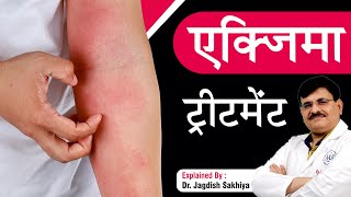 एक्जिमा ट्रीटमेंट Treatment  How to get rid of Eczema  Sakhiya Skin Clinic  Dr Jagdish Sakhiya [upl. by Mercola]