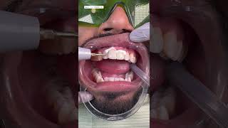 Broken Teeth Cap Treatment  Tooth Repair  Filling Process  dentalcrowns smilemakeover shorts [upl. by Ahsenav]