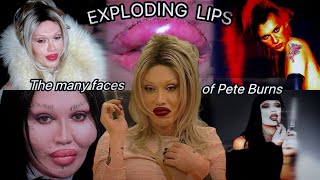 Pete Burns insane story [upl. by Esenaj967]