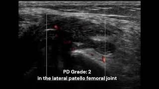 PD ultrasonography and CPSP after TKA  Supplementary video ID 403641 [upl. by Dwyer]