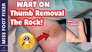 Wart On Thumb Removal Full Treatment By Miss Foot Fixer [upl. by Ylsel720]