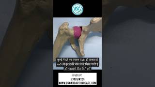 कूल्हे में दर्द क्यों होता हैकैसे पहचाने कूल्हे के AVN कोHip pain treatmentavntreatment [upl. by Chemar]