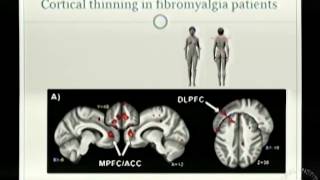 Brain Changes in Chronic Pain Patients [upl. by Nymassej865]