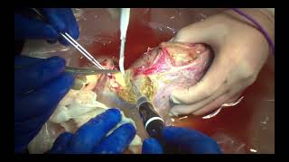 Ex Vivo Liver Resection [upl. by Engen]