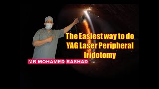 The easiest way to do Laser Peripheral Iridotomy علاج الجلوكوما الحادة و إنسداد زاوية العين بالليزر [upl. by Annhej]