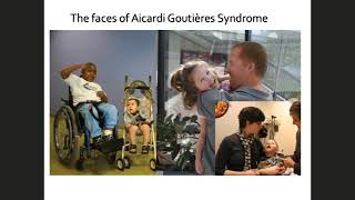 Aicardi Goutieres Syndrome AGS and other Calcifying Leukodystrophies [upl. by Aneeuq]