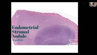 Mesenchymal Tumors of the Uterus part 2 Hospital 103 series [upl. by Assiluj]