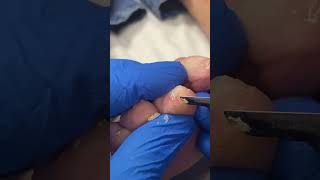 Experience relief Watch how a podiatrist in Australia removes a toe callus [upl. by Aneger]