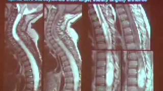 Imaging Patients with Myelopathy [upl. by Casimir]