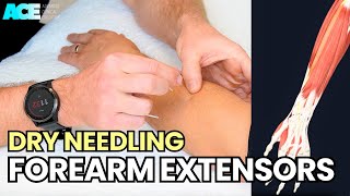 Dry Needling Forearm Extensors [upl. by Sherwin]