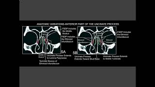 Uncinate process [upl. by Coreen]