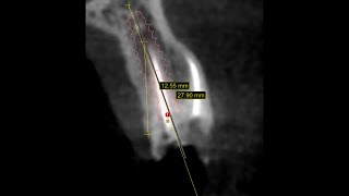 Atraumatic extraction  Immediate implant placement  upper first premolar [upl. by Enileuqcaj]