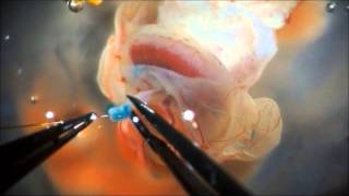 Cannulation of the umbilical artery [upl. by Neeluqcaj]