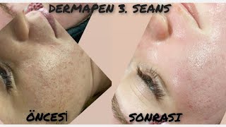 DERMAPEN 3SEANS  CİLT BAKIMI  LEKE TEDAVİSİ [upl. by Ellenohs189]