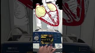 Atrial Fibrillation Cardioversion Video and Animation 🫀🔌 medical cardiology [upl. by Cobb277]