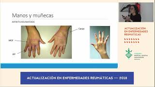 Diferencias clínicas Artrosis versus Artritis Reumatoide [upl. by Festus162]