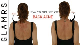 How To Get Rid of Back Acne the Natural Way  Effective Home Remedies [upl. by Oirromed]