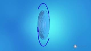 What is a multifocal toric intraocular lens IOL [upl. by Nedlog]