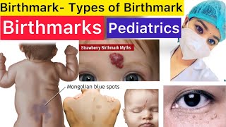 Pediatrics  Birthmarks  Types of Birthmarks  Stroke Spot  Milia Spot  Strawberry Spot  Pedia [upl. by Artemisa642]