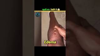 Edema Ko kese theek Karen edema fects shorts [upl. by Constancy]