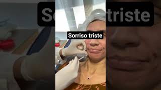 toxina botulínica para sorriso triste sabe aquele cantinho da boca caído botox para sorriso triste [upl. by Nilats888]