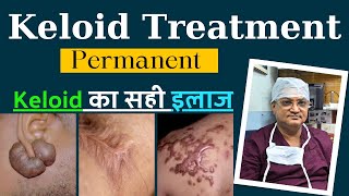 Keloid Removal Treatment  Keloid का इलाज  Dr Naren Pandey [upl. by Aehtrod]