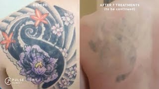 Laser Tattoo Removal  Before and Afters Gallery [upl. by Koerlin130]