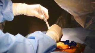 Vertebroplasty Live Procedure Hussien ElMaghraby [upl. by Htiderem]