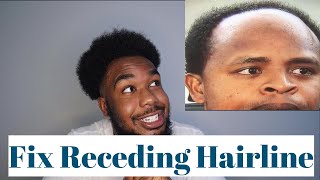 Fix your Receding Hairline [upl. by Annette]