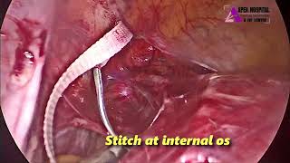 Laparoscopic Abdominal Cerclage by Dr R K Mehta  Apex Hospital Sirsa [upl. by Beall591]