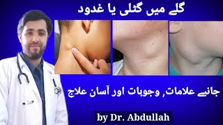 Swollen Lymph Nodes In Neck Symptoms Causes amp Treatment  Lymphadenopathy  Gale Ki Gilti Ya Ganth [upl. by Hersch255]