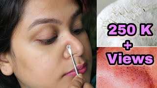 HOW TO REMOVE BLACKHEADS INSTANTLY amp PERMANENTLY  PAINLESS HOME REMEDY [upl. by Akela]