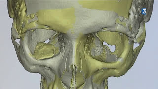 L’imprimante 3D révolutionne la chirurgie maxillofaciale  France 3 [upl. by Vihs]