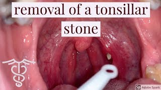 Removal of a tonsillar stone  patient education video by Dr Carlo Oller [upl. by Kreis]