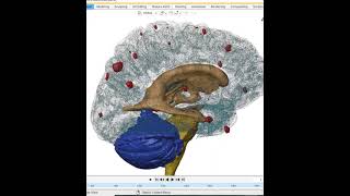 Cysticercosis 3D reconstruction of a patient [upl. by Thea]